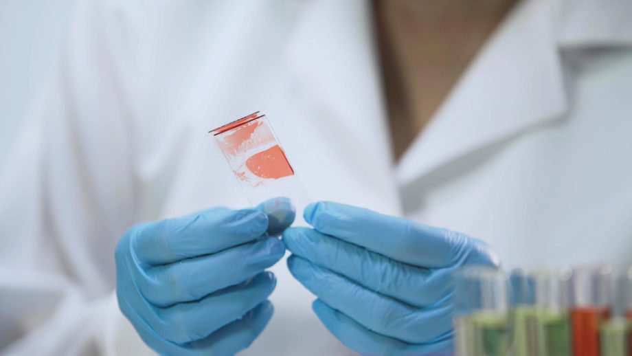 Medical worker analyzing microbiological specimens, blood sample, HIV test screening epatite C