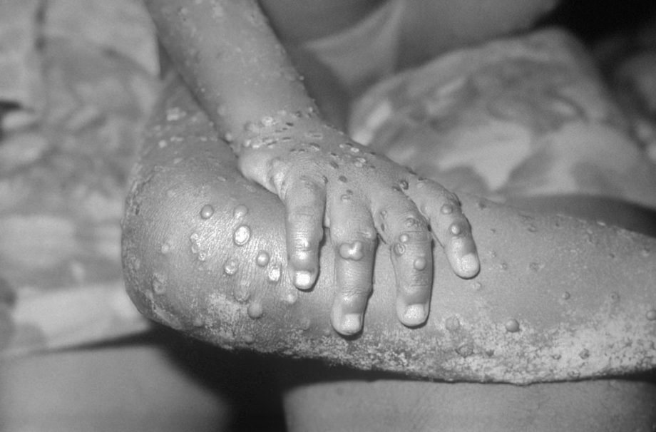 1093px-Monkeypox mpox
