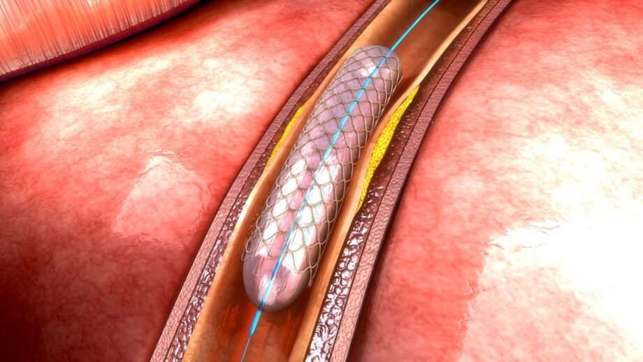 stent