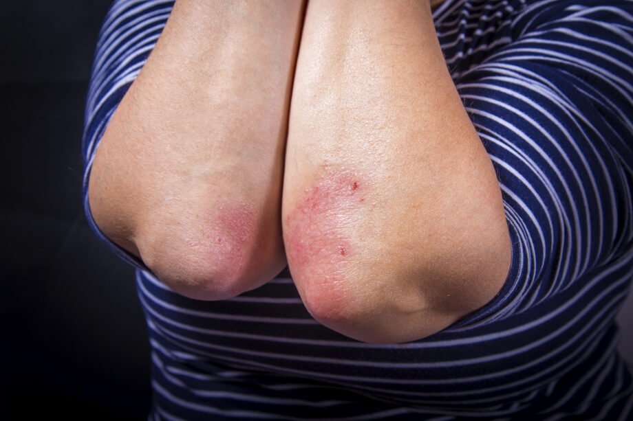 psoriasi